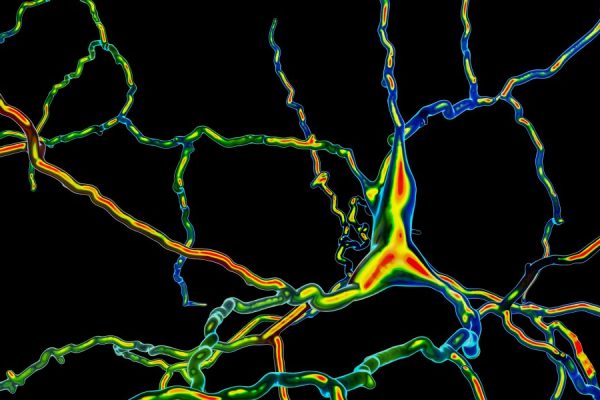A biotech company says it put dopamine-making cells into people’s brains